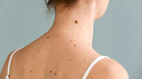 Observing new moles, growths, or bumps for potential concerns