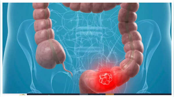 Persistent abdominal pain is an early indicator