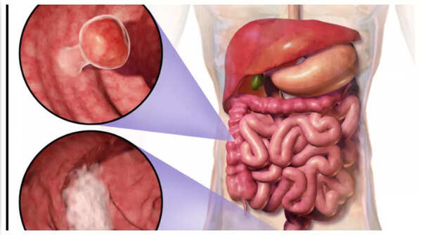 Blood in stool should not be ignored