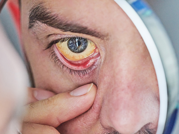 Jaundice: yellowing of the eyes