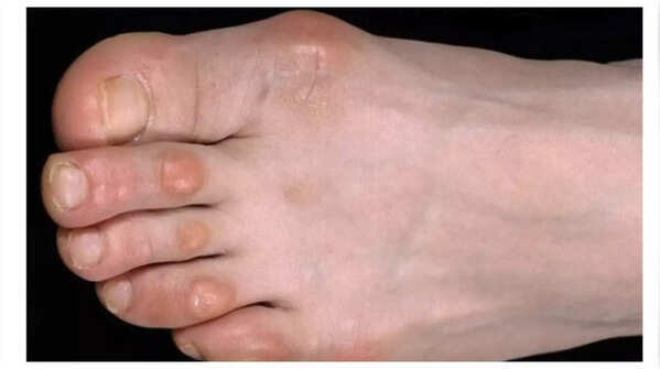 Painful lumps on fingers or toes linked to heart infection