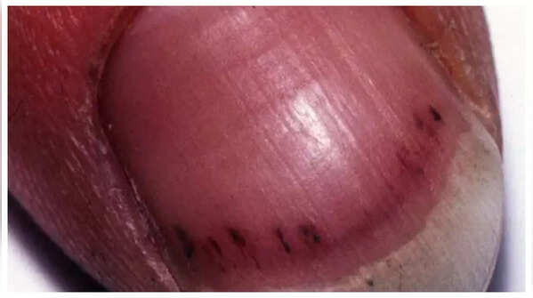 Red or purple lines under nails indicate blood vessel damage