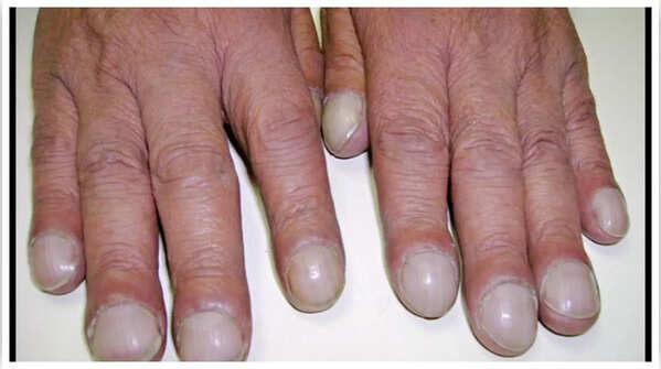 Changes in nail shape signaling potential heart issues