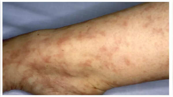 Net-like purple pattern on skin linked to cholesterol embolization