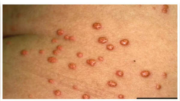 Yellowish-orange bumps on the skin indicating high cholesterol
