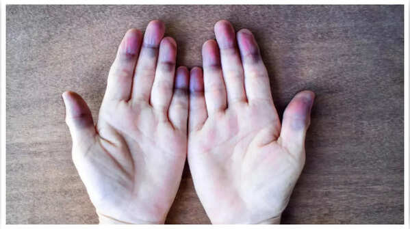 Blue or purple skin discoloration as a heart disease sign
