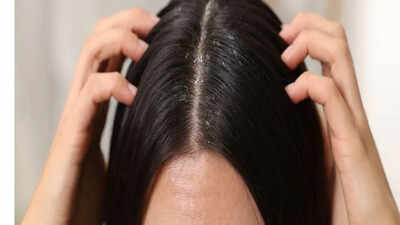 Close-up of flakes on hair, highlighting the difference between dandruff and dry scalp