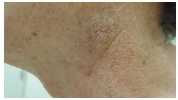 Dark patches of skin on neck