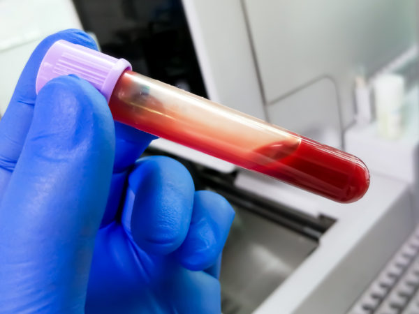 Blood sample in test tube
